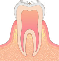 むし歯の進行C0