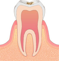 むし歯の進行C1