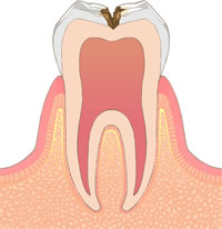 むし歯の進行C2