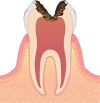 むし歯の進行C3