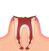 むし歯の進行C4